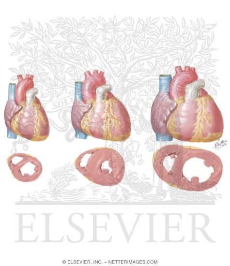 Watermarked preview of unlabeled image: Normal Heart and Hypertensive Hearts