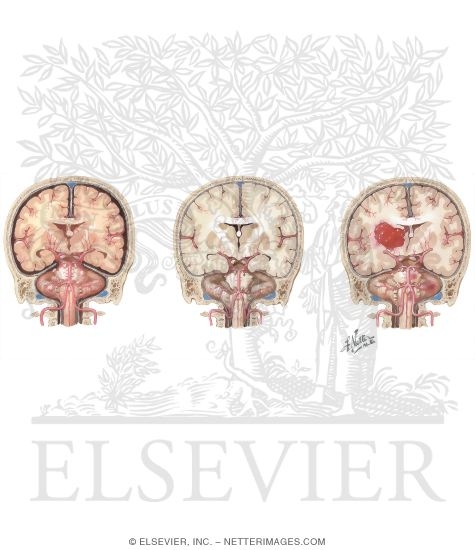 Watermarked preview of unlabeled image: Normal Brain, Hypertensive Encephalopathy, Hemorrhage