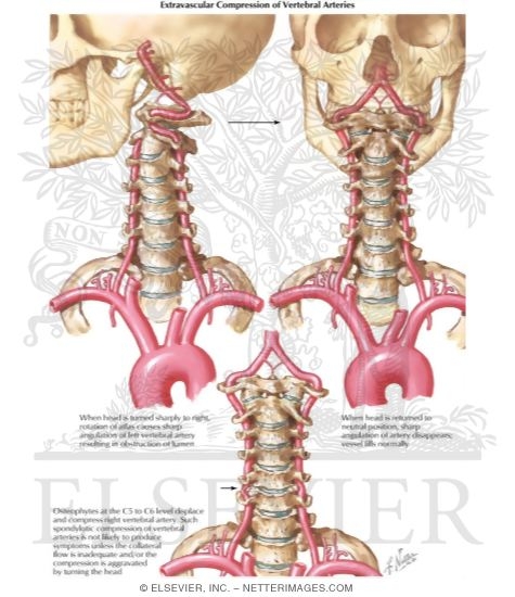 Compression of Vertebral Arteries