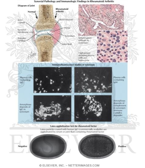 Synovial Pathology and Immunologic Findings in Rheumatoid Arthritis