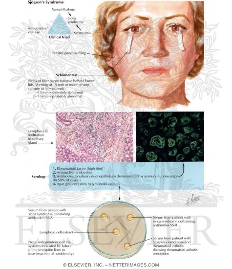 Watermarked preview of labeled image: Sjogren's Syndrome