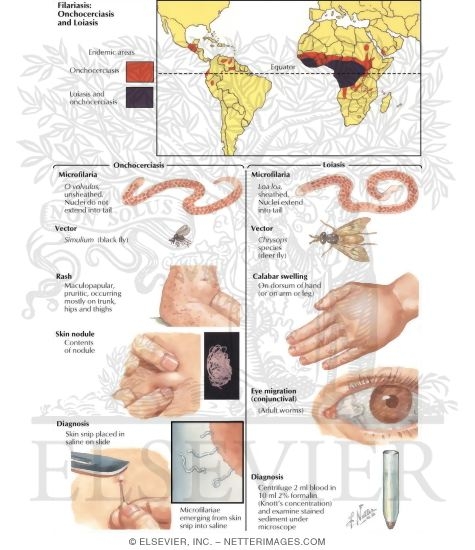 Filariasis: Onchocerciasis and Lioasis