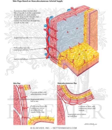 Watermarked preview of labeled image: Skin Flaps Based on Direct Cutaneous Arterial Supply