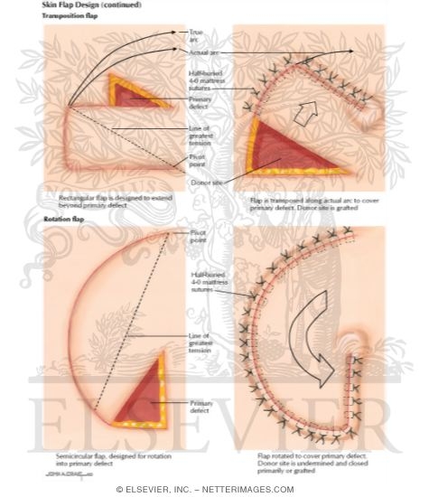 Watermarked preview of labeled image: Skin Flap Design