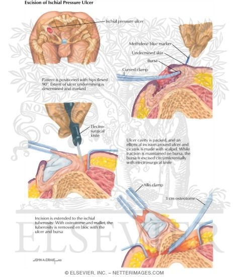 Excision of Ischial Pressure Ulcer