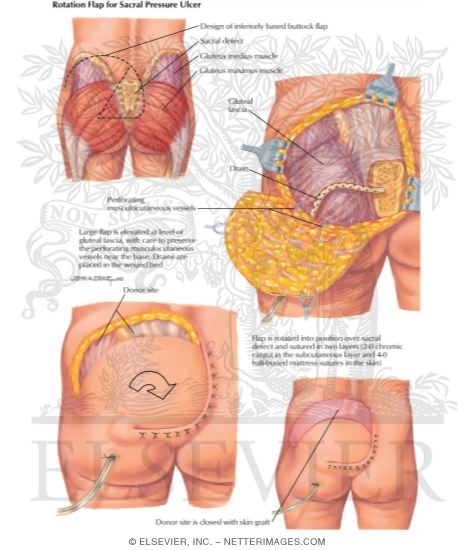 Rotation Flap for Sarcal Pressure Ulcer