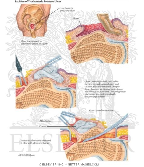 Watermarked preview of labeled image: Excision of Trochanteric Pressure Ulcer