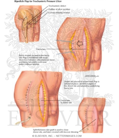 Watermarked preview of labeled image: Bipedic Flap for Trochanteric Pressure Ulcer