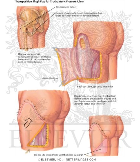 Transposition Thigh Flap for Trochanteric Pressure Ulcer