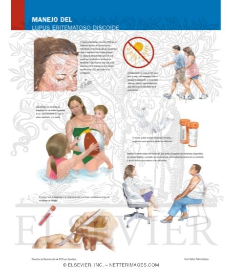 Managing Your Discoid Lupus Erythematosus