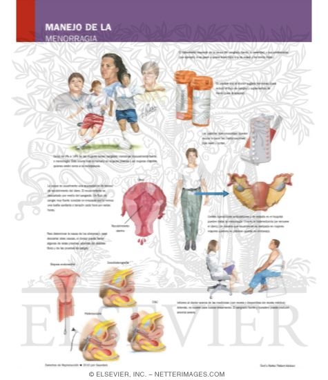 Watermarked preview of labeled image: Managing Your Menorrhagia