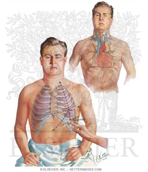 Watermarked preview of unlabeled image: Emphysema