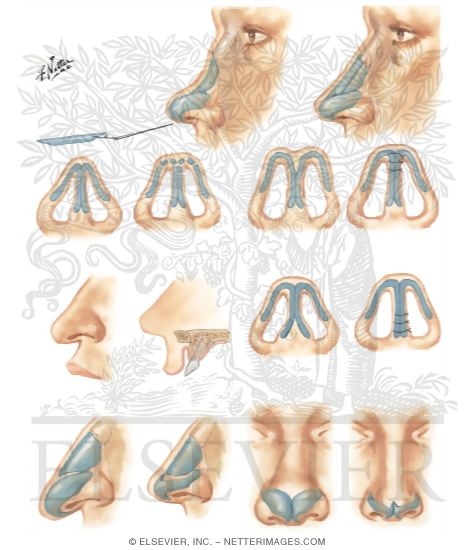 Watermarked preview of unlabeled image: Saddle Nose: Tip Deformities
