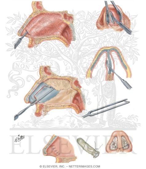 Submucous Resection