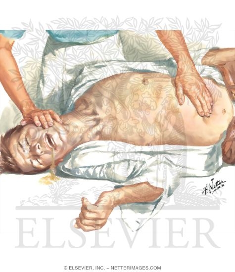 Watermarked preview of unlabeled image: Relief of Distention