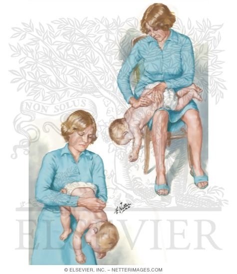 Watermarked preview of unlabeled image: Heimlich Maneuver: Infant Victim