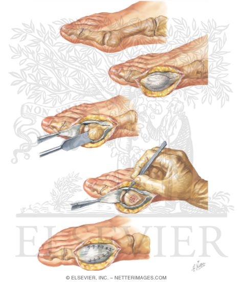Silver Operation for Bunion