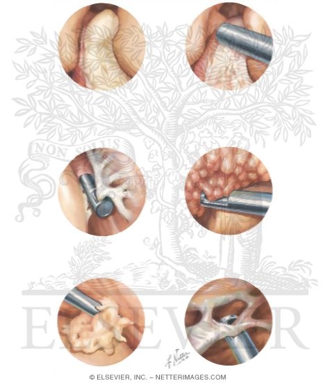 Watermarked preview of unlabeled image: Arthroscopic Extrasynovial Surgery