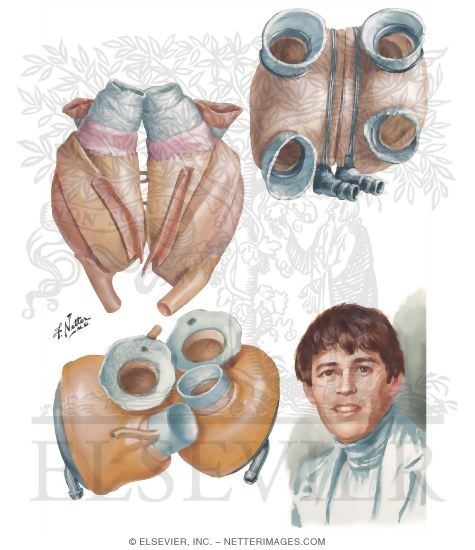 Watermarked preview of unlabeled image: Earlier Artificial Heart Models