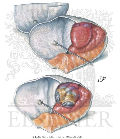 Watermarked preview of unlabeled image: Conforming Heart Design to the Human Thorax