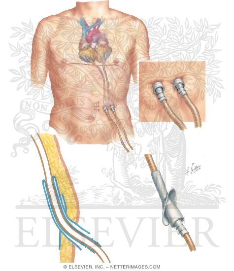 Watermarked preview of unlabeled image: Emergence of the Tubes to the Pneumatic Heart Driver