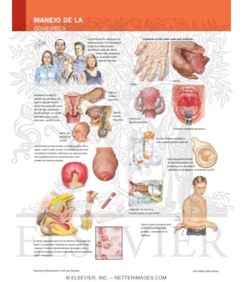Managing Your Gonorrhea