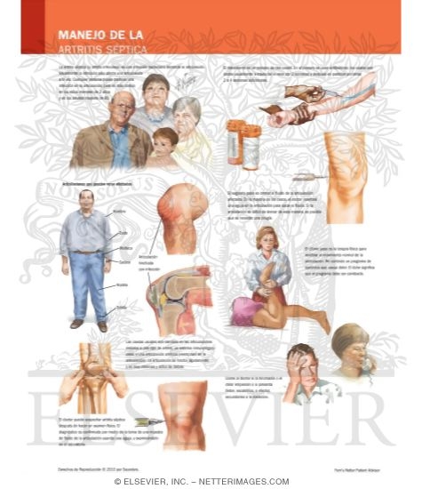 Watermarked preview of labeled image: Managing Your Septic Arthritis