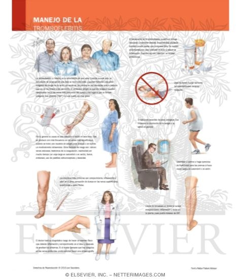 Watermarked preview of labeled image: Managing Your Thrombophlebitis