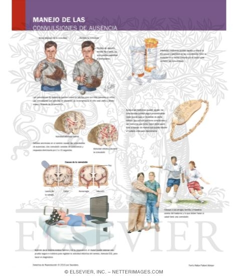 Managing Your Absence Seizures