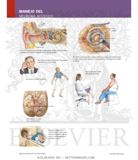 Watermarked preview of labeled image: Managing Your Acoustic Neuroma