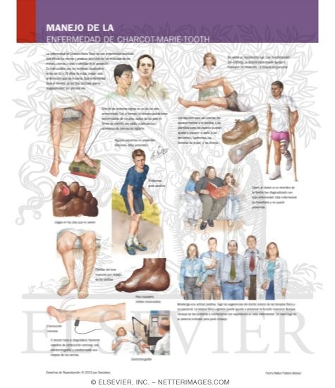 Watermarked preview of labeled image: Managing Your Charcot-Marie Tooth Disease