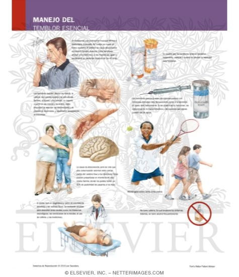 Managing Your Essential Tremor