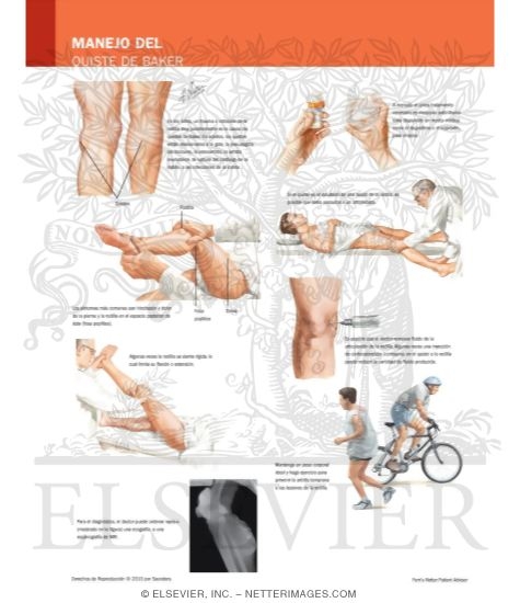 Managing Your Baker's Cyst