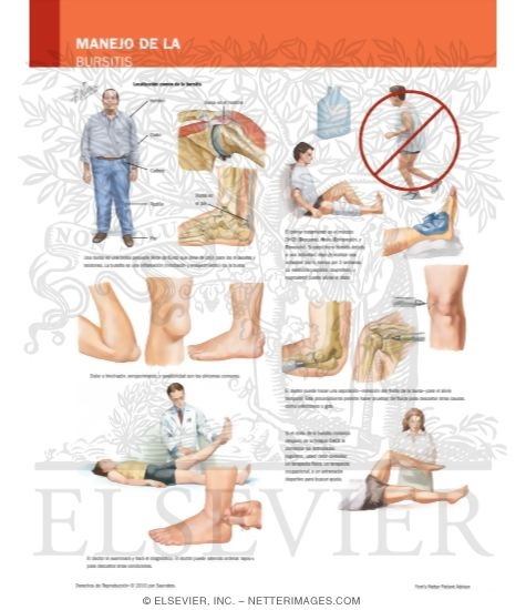 Watermarked preview of labeled image: Managing Your Bursitis