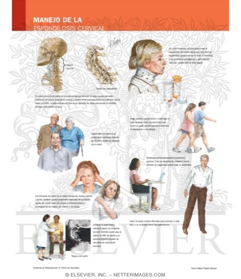Managing Your Cervical Spondylosis