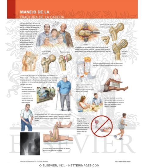 Watermarked preview of labeled image: Managing Your Hip Fracture