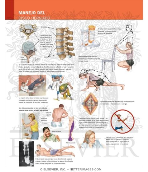 Manejo Del Disco Herniado