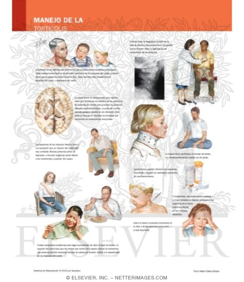 Managing Your Torticollis