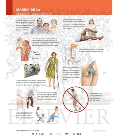 Manejo de la Bursitis Trocantérica