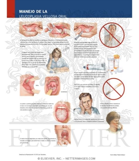 Manejo de la Leucoplasia Vellosa Oral