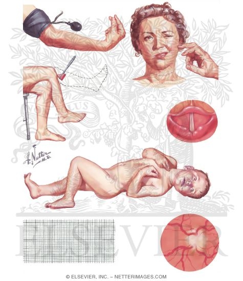 Watermarked preview of unlabeled image: Clinical Manifestations of Acute Hypocalcemia