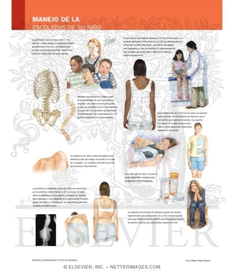 Watermarked preview of labeled image: Understanding and Managing Your Child's Scoliosis