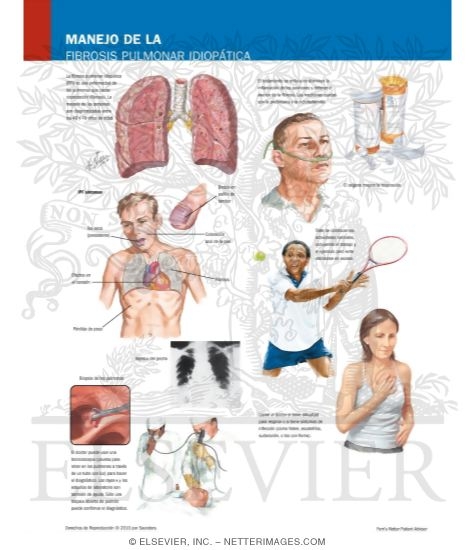 Managing Your Idiopathic Pulmonary Fibrosis