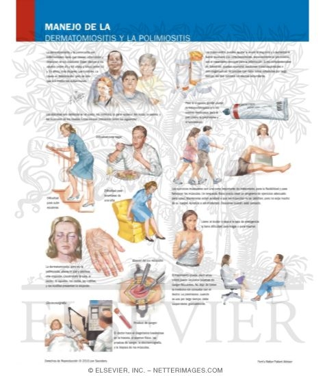 Watermarked preview of labeled image: Managing Your Dermatomyositis and Polymyositis