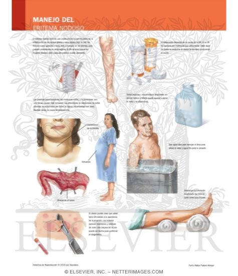 Managing Your Erythema Nodosum