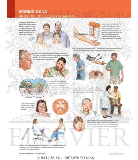 Watermarked preview of labeled image: Managing Your Giant Cell Arteritis