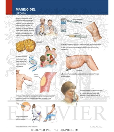 Managing Your Lipoma