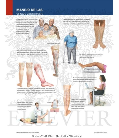 Watermarked preview of labeled image: Managing Your Varicose Veins