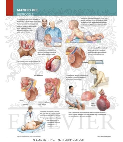 Watermarked preview of labeled image: Managing Your Hydrocele