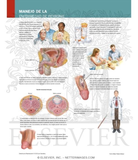 Watermarked preview of labeled image: Managing Your Peyronie's Disease